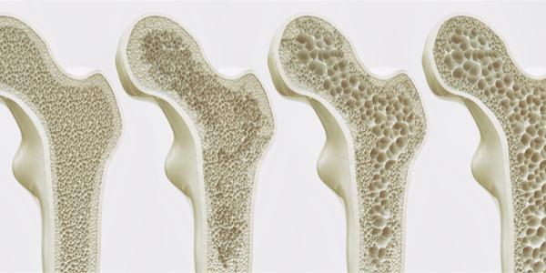 Ostarine and Osteoporosis